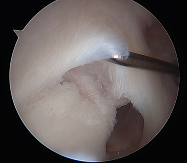 SLAP tear